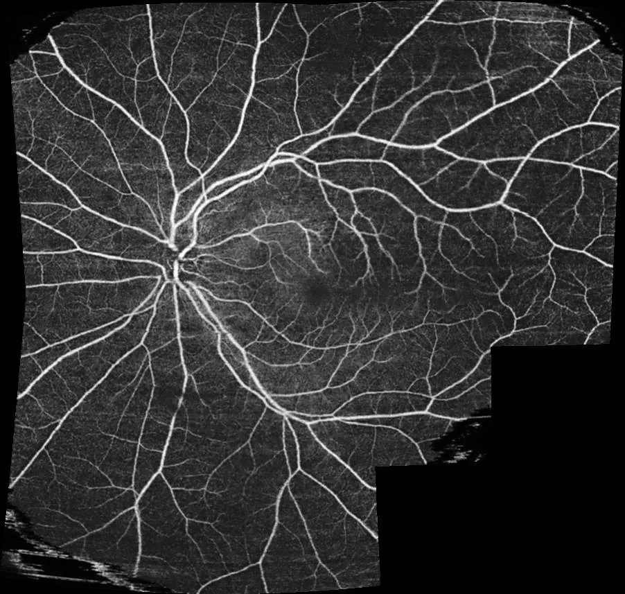OCTアンギオグラフィー(光干渉断層血管撮影)