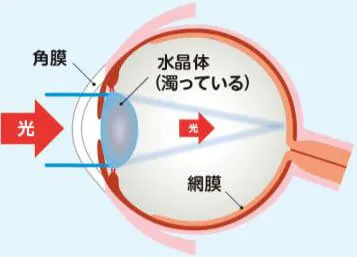 白内障の目