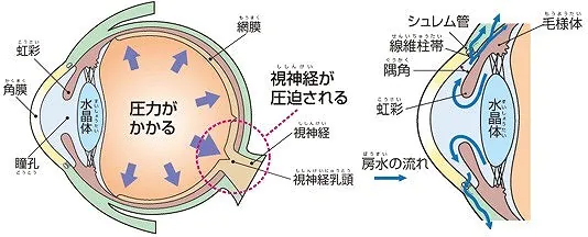 緑内障とは