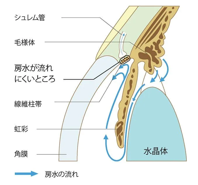 緑内障の種類と原因