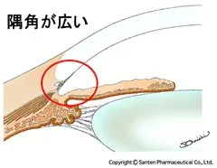 原発開放隅角緑内障