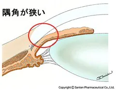 原発閉塞隅角緑内障