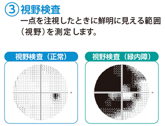 視野検査