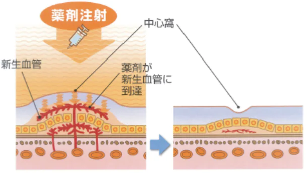 加齢黄斑変性