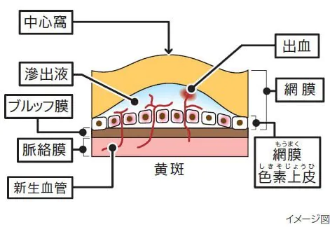 病的近視における脈絡膜新生血管