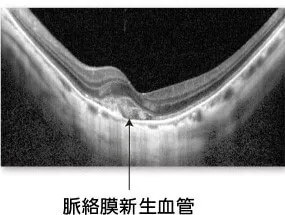 ＜病的近視における脈絡膜新生血管＞