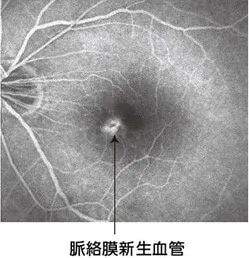 ＜病的近視における脈絡膜新生血管＞