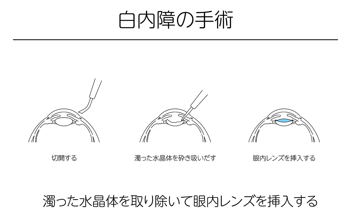 多焦点眼内レンズを希望される患者様へ