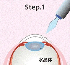 目に小さく切開を入れます。