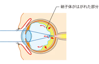 硝子体の変性