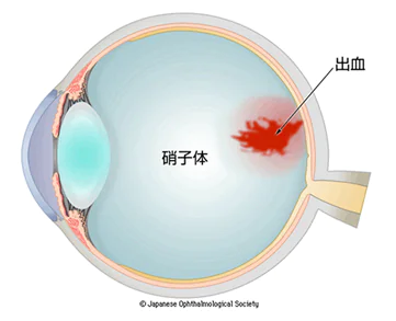 硝子体出血