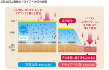 正常な目とドライアイの目の方面