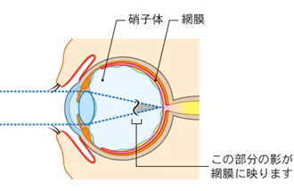 硝子体の変性