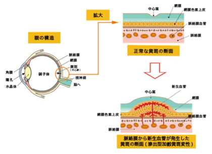 滲出型加齢黄斑変性