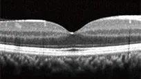 正常な網膜