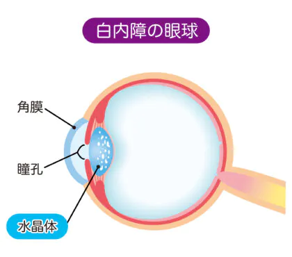 中間透光体混濁