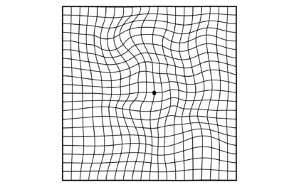 黄斑前膜（黄斑上膜）